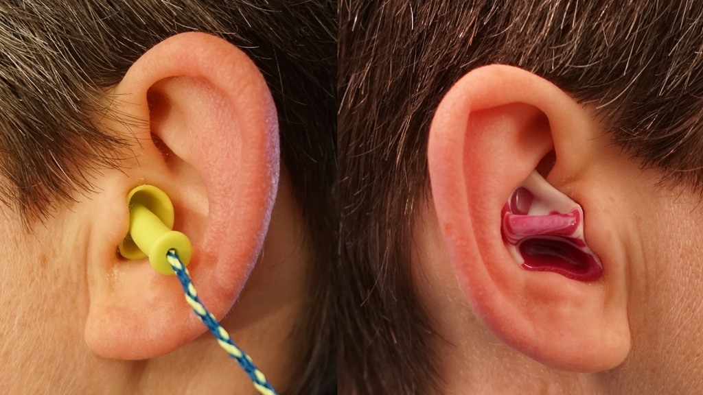 Ein Ohr mit Ohrstöpsel und ein Ohr mit Otoplastik